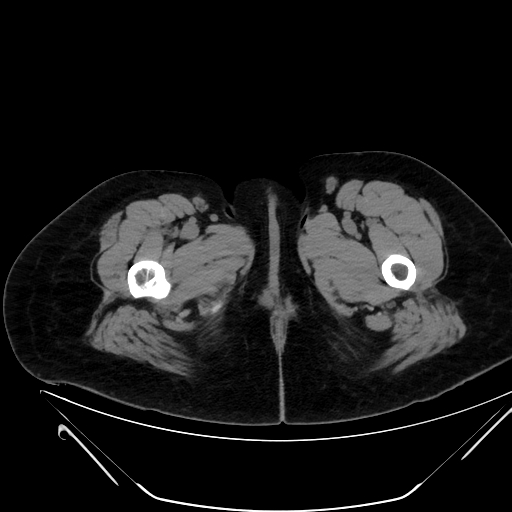 Bilateral ovarian mature cystic teratomas (Radiopaedia 79373-92457 Axial non-contrast 111).jpg