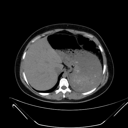 File:Bilateral ovarian mature cystic teratomas (Radiopaedia 79373-92457 Axial non-contrast 2).jpg
