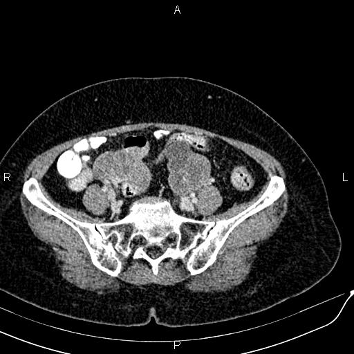 Bilateral ovarian serous cystadenocarcinoma (Radiopaedia 86062-101989 B 76).jpg
