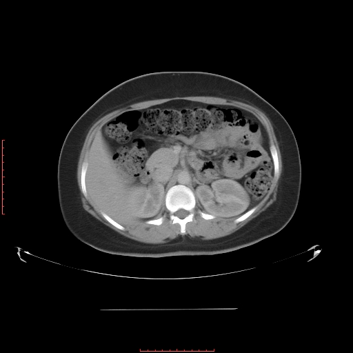 File:Bilateral ovarian serous cystadenocarcinoma with right ovarian torsion (Radiopaedia 32640-33611 A 14).jpg
