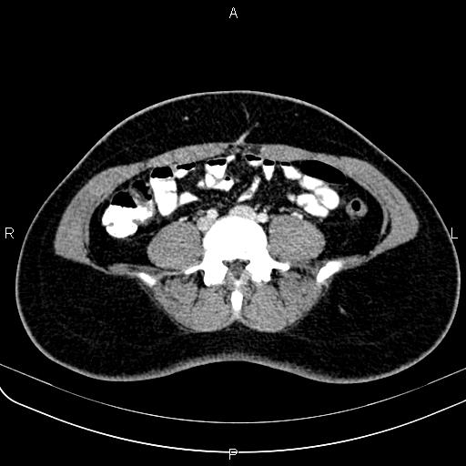 File:Bilateral ovarian teratoma (Radiopaedia 83131-97503 Axial With contrast 2).jpg