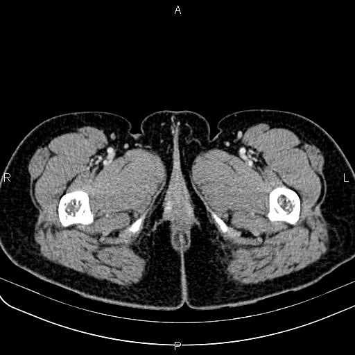 Bilateral ovarian teratoma (Radiopaedia 83131-97503 Axial With contrast 95).jpg