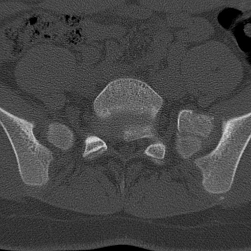 File:Bilateral pars defect (Radiopaedia 26691-26846 Axial bone window 69).jpg