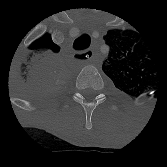 File:Bilateral perched facets with cord injury (Radiopaedia 45587-49713 Axial bone window 117).jpg