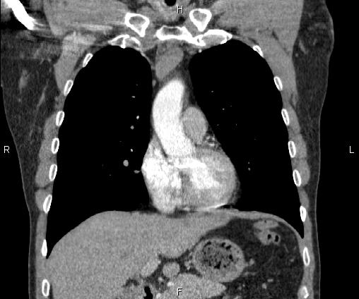 File:Bilateral pulmonary AVM (Radiopaedia 83134-97505 C 29).jpg