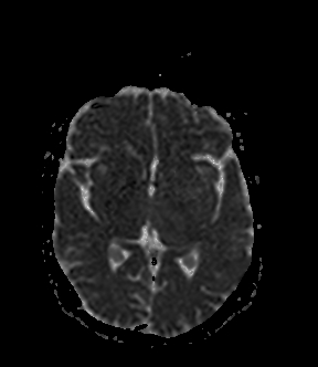 File:Bilateral thalamic glioma (Radiopaedia 65852-75009 Axial ADC 11).jpg