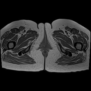 Bilateral tubo-ovarian abscesses (Radiopaedia 58635-65829 Axial T1 C+ 53).jpg