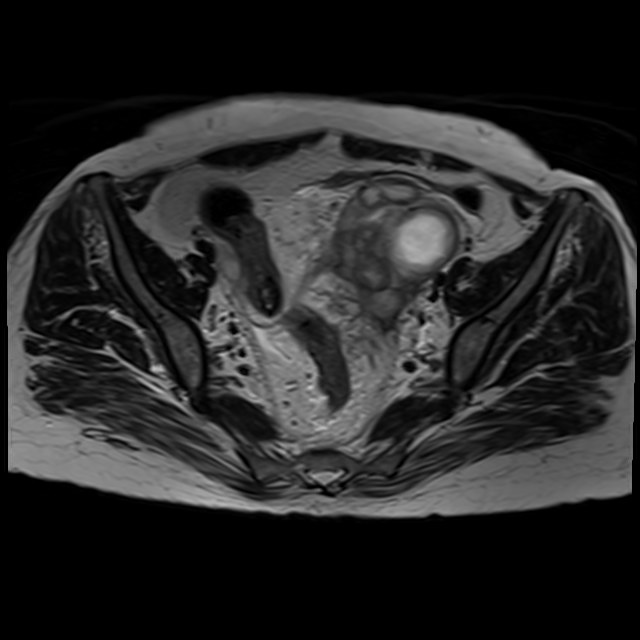Bilateral tubo-ovarian abscesses (Radiopaedia 58635-65829 Axial T2 18).jpg