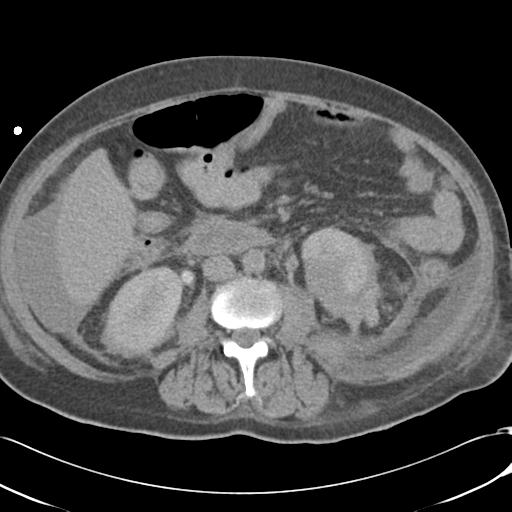 Bladder rupture post renal biopsy (Radiopaedia 30863-31572 Axial non-contrast 44).jpg