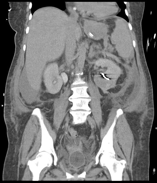 Bladder rupture post renal biopsy (Radiopaedia 30863-31572 Coronal non-contrast 35).jpg