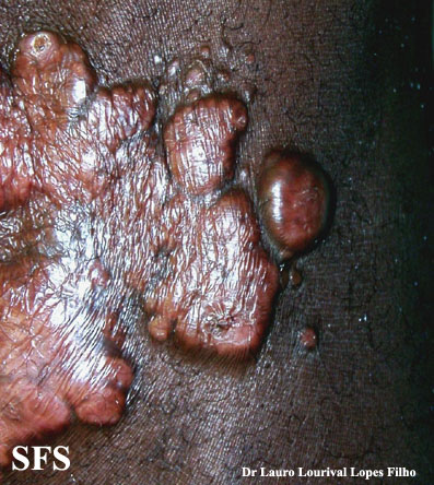 Blastomycosis-Keloidal Blastomycosis (Dermatology Atlas 3).jpg