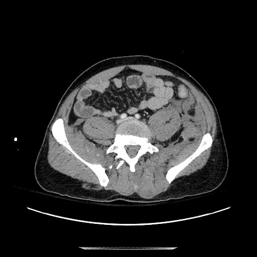 Blunt abdominal trauma with solid organ and musculoskelatal injury with active extravasation (Radiopaedia 68364-77895 A 107).jpg