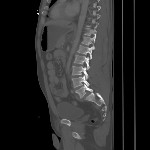 Blunt abdominal trauma with solid organ and musculoskelatal injury with active extravasation (Radiopaedia 68364-77895 Sagittal bone window 59).jpg