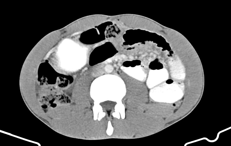 Blunt injury to the small bowel (Radiopaedia 74953-85987 A 94).jpg