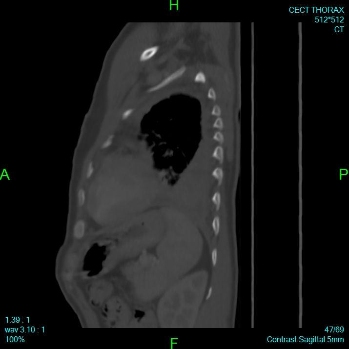 Bone metastases from lung carcinoma (Radiopaedia 54703-60937 Sagittal bone window 47).jpg