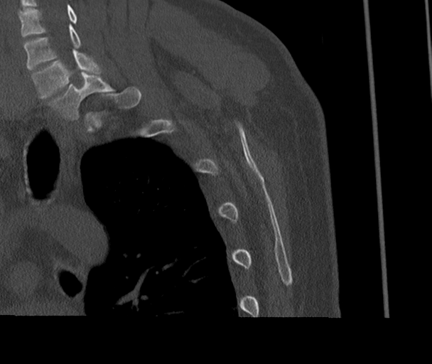 Bony Bankart and Hill-Sachs lesions (Radiopaedia 33622-34727 Sagittal bone window 71).png