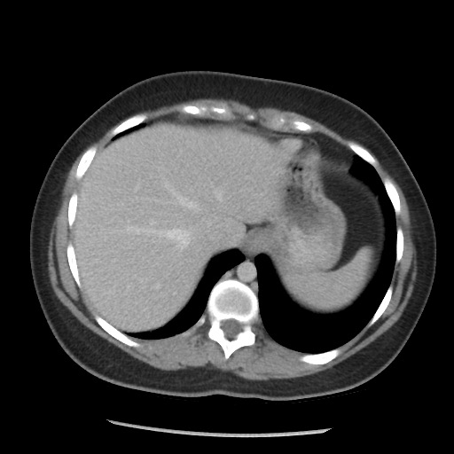 File:Borderline mucinous tumor (ovary) (Radiopaedia 78228-90808 A 67).jpg
