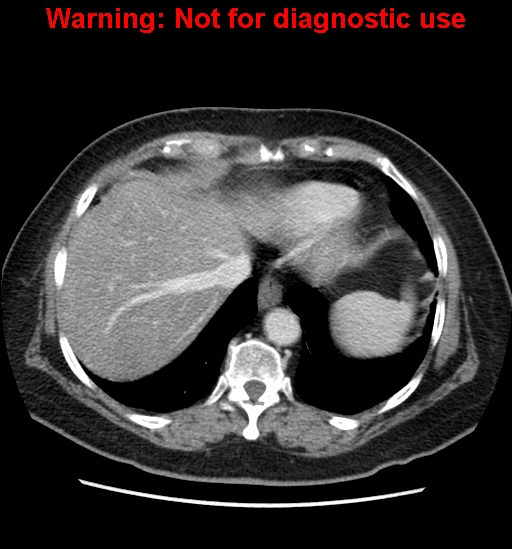 File:Bosniak renal cyst - type II (Radiopaedia 23404-23468 D 11).jpg
