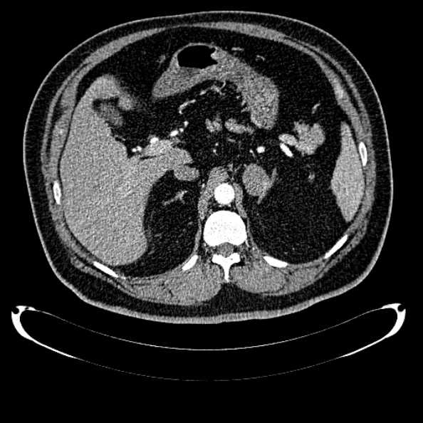 Bosniak renal cyst - type IV (Radiopaedia 24244-24518 B 87).jpg