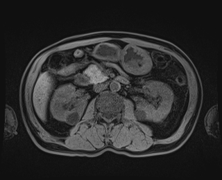 Bouveret syndrome (Radiopaedia 61017-68856 Axial T1 fat sat 43).jpg