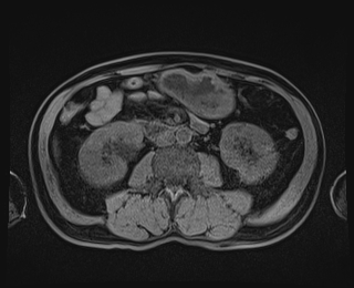 Bouveret syndrome (Radiopaedia 61017-68856 Axial T1 fat sat 50).jpg
