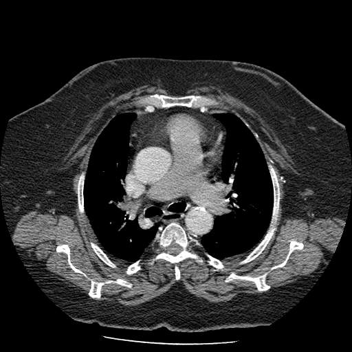 Bovine aortic arch - right internal mammary vein drains into the superior vena cava (Radiopaedia 63296-71875 A 58).jpg