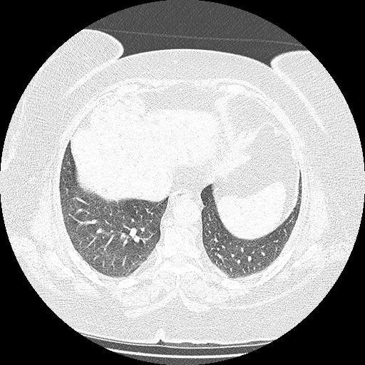 Bovine aortic arch - right internal mammary vein drains into the superior vena cava (Radiopaedia 63296-71875 Axial lung window 125).jpg