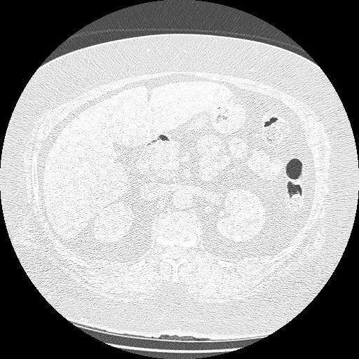 Bovine aortic arch - right internal mammary vein drains into the superior vena cava (Radiopaedia 63296-71875 Axial lung window 207).jpg