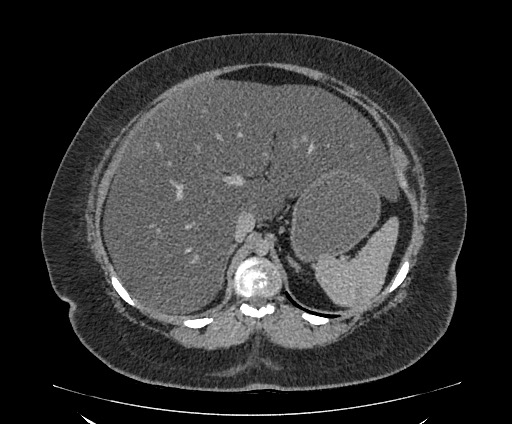 File:Bowel and splenic infarcts in acute lymphocytic leukemia (Radiopaedia 61055-68913 A 41).jpg