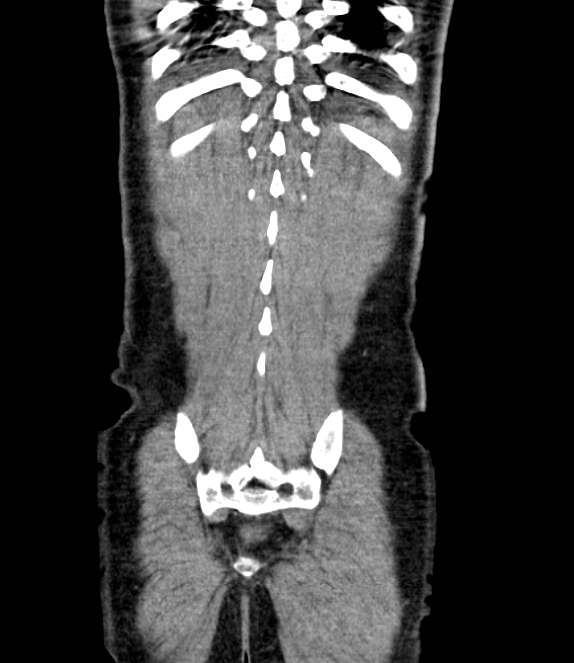 Bowel obstruction from colon carcinoma (Radiopaedia 22995-23028 C 68).jpg