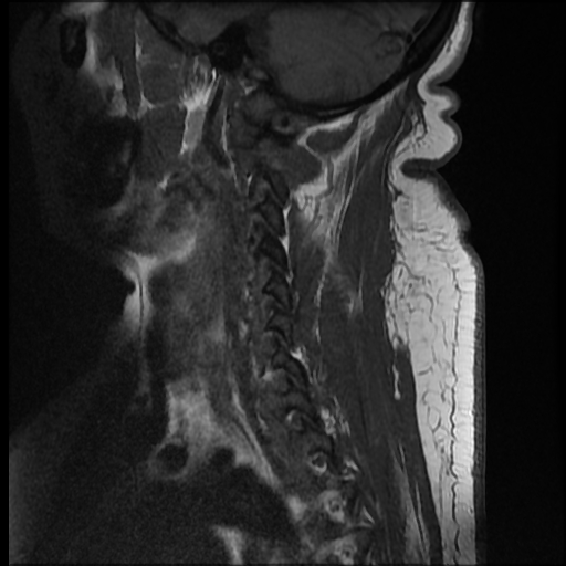File:Brachial plexopathy (Radiopaedia 21844-21806 Sagittal T1 2).jpg