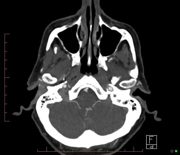 Brachiocephalic trunk stenosis (Radiopaedia 87242-103519 A 58).jpg