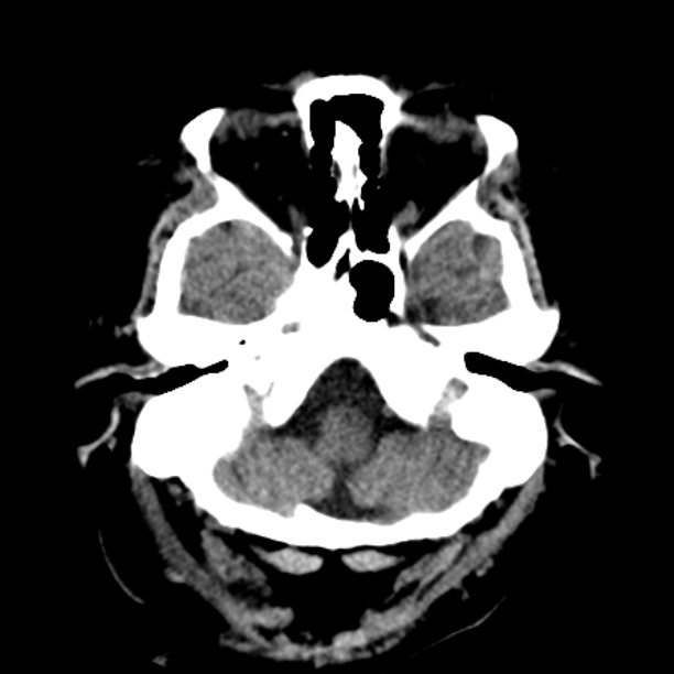 Brain cortical laminar necrosis (Radiopaedia 25822-25971 Axial non-contrast 6).jpg