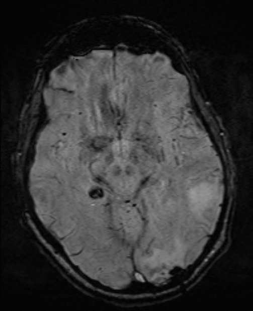Brain metastases - lung cancer primary (Radiopaedia 75060-86115 Axial SWI 28).jpg