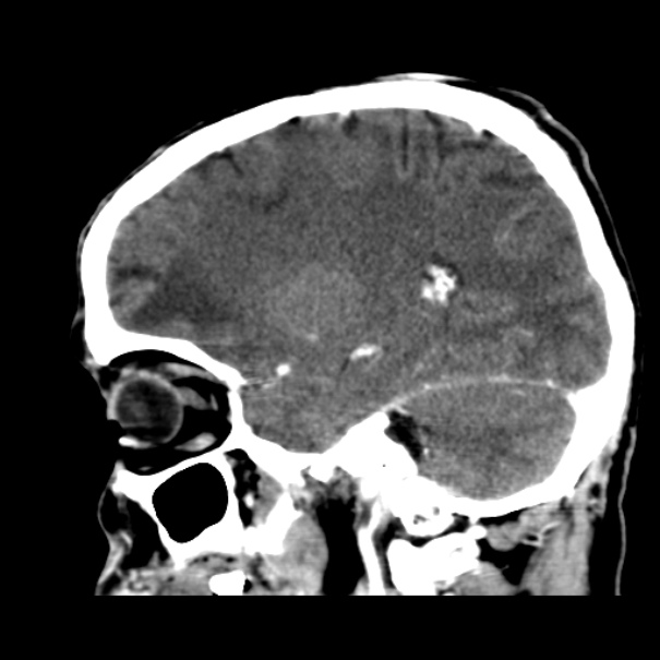 Brain metastases from lung cancer (Radiopaedia 24480-24781 C+ delayed 39).jpg