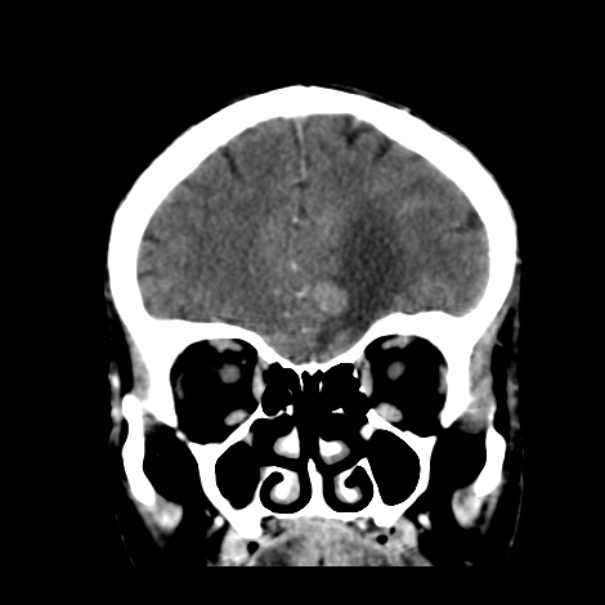 Brain metastases from lung cancer (Radiopaedia 24480-24781 Coronal C+ delayed 15).jpg