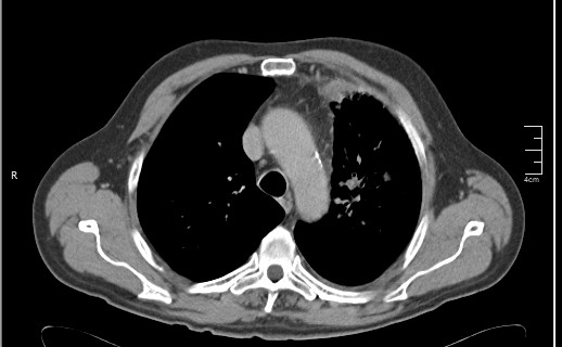 File:Brain metastases from squamocellular lung cancer (Radiopaedia 56515-63219 B 23).jpg