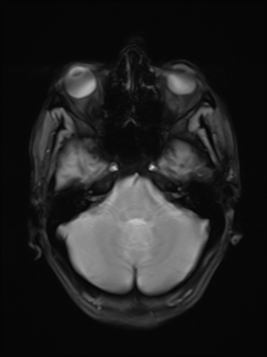 File:Brain metastasis as initial presentation of non-small cell lung cancer (Radiopaedia 65122-74126 Axial T2* 6).jpg