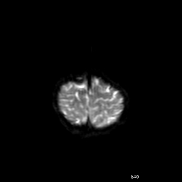File:Brainstem ganglioglioma (Radiopaedia 10763-11224 Axial DWI 2).jpg