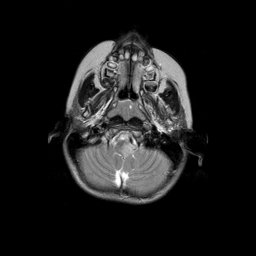 File:Brainstem ganglioglioma (Radiopaedia 10763-11224 Axial T2 17).jpg