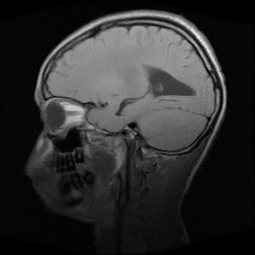 File:Brainstem glioma (Radiopaedia 30923-31624 Sagittal T1 6).jpg