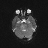 Brainstem glioma (Radiopaedia 67531-76922 Axial DWI 9).jpg
