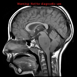 File:Brainstem glioma (Radiopaedia 9444-10124 Sagittal T1 5).jpg