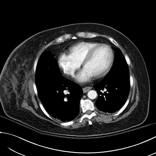 Breast carcinoma with pathological hip fracture (Radiopaedia 60314-67974 A 36).jpg