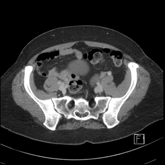 File:Breast metastases from renal cell cancer (Radiopaedia 79220-92225 C 86).jpg