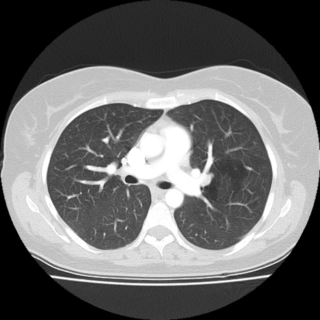 Bronchial atresia (Radiopaedia 22965-22992 Axial lung window 30).jpg