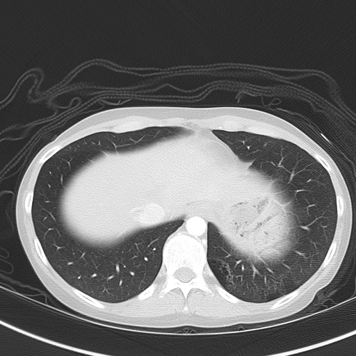 Bronchial atresia (Radiopaedia 73677-84470 Axial lung window 49).jpg