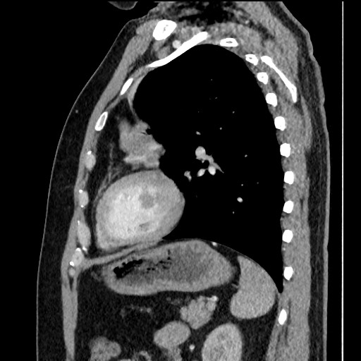 Bronchial carcinoid tumor (Radiopaedia 67377-76764 E 49).jpg