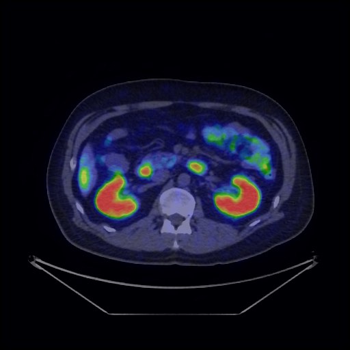 Bronchial carcinoid tumor (Radiopaedia 67377-76765 68Ga-DOTATATE PET-CT 49).jpg