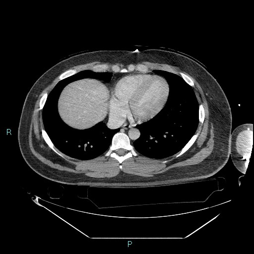 Bronchial carcinoid tumor (Radiopaedia 78272-90870 C 86).jpg